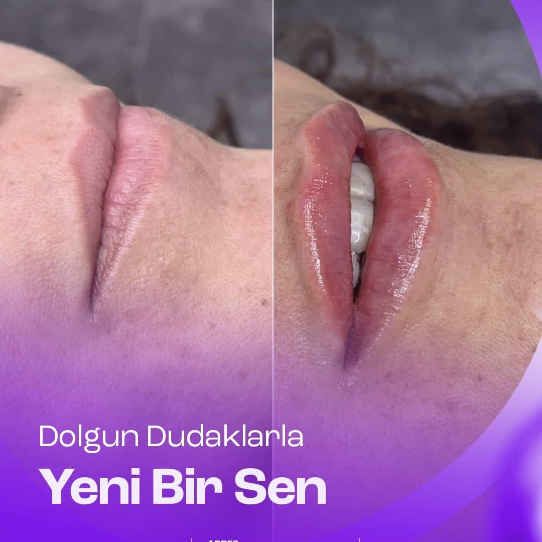 Dudak dolgusu sonucu