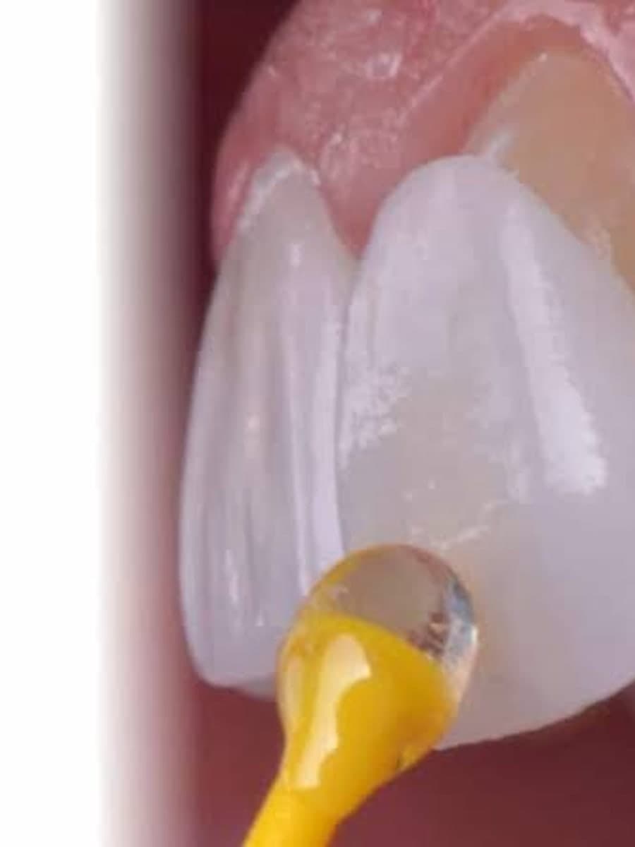 Porselen lamina restorasyonlarının hazırlandığı klinik çalışma alanı