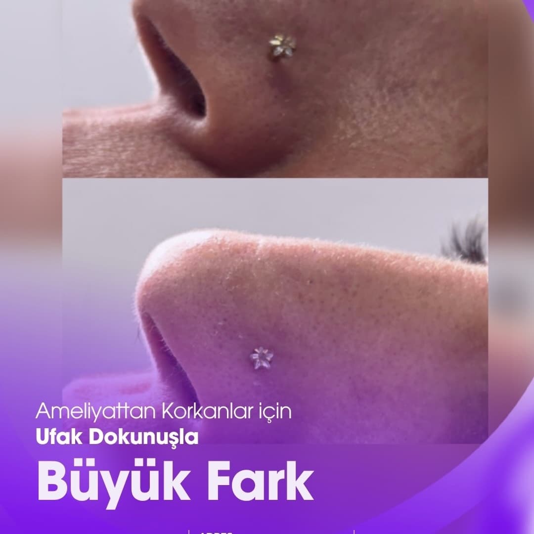 Burun dolgusu öncesi ve sonrası